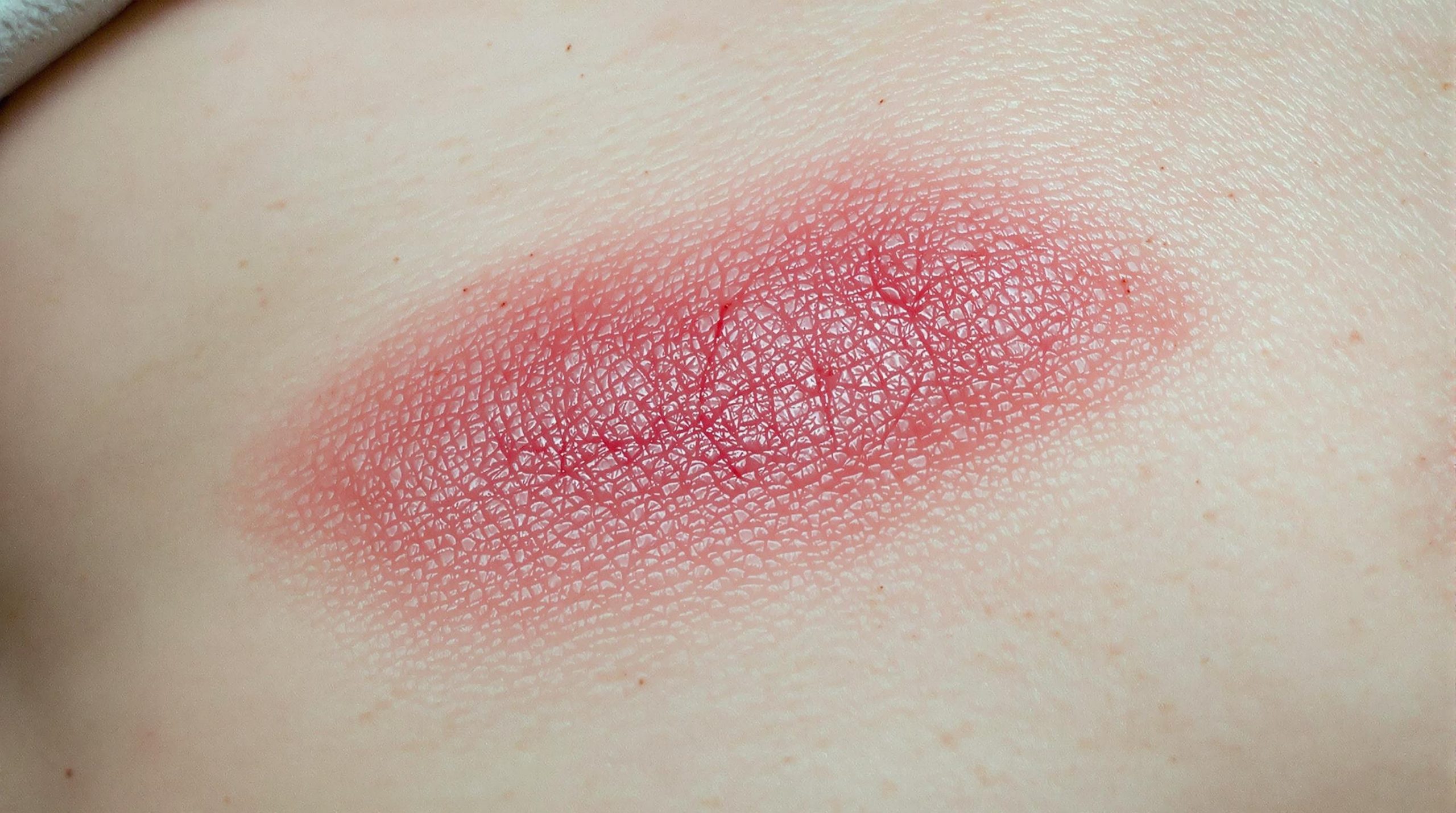 Cicatrice boursouflée après opération : causes, traitements et signes d'infection - Maquillage Yeux Marron