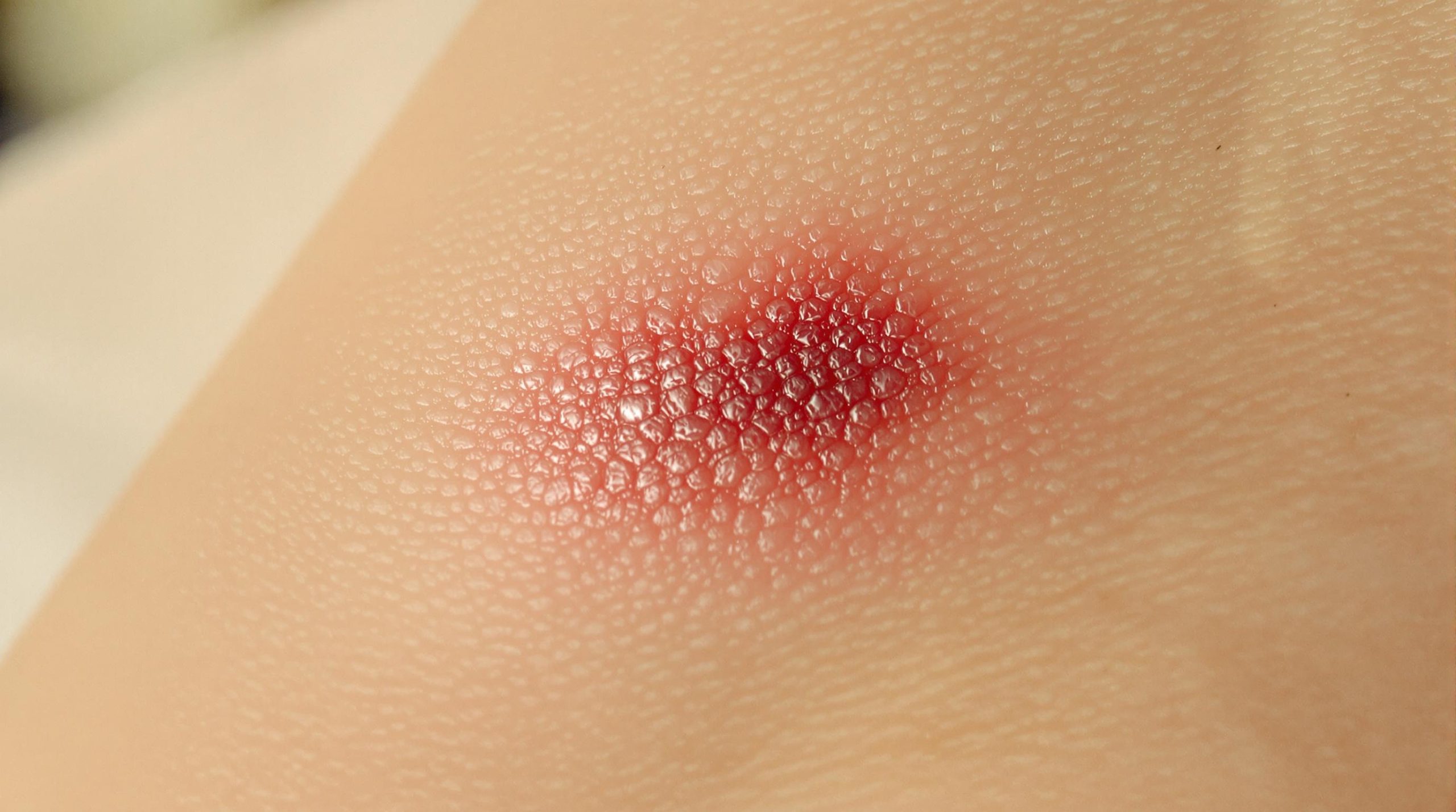 Vieille cicatrice qui rougit : causes et solutions - Maquillage Yeux Marron